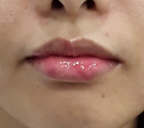 Before