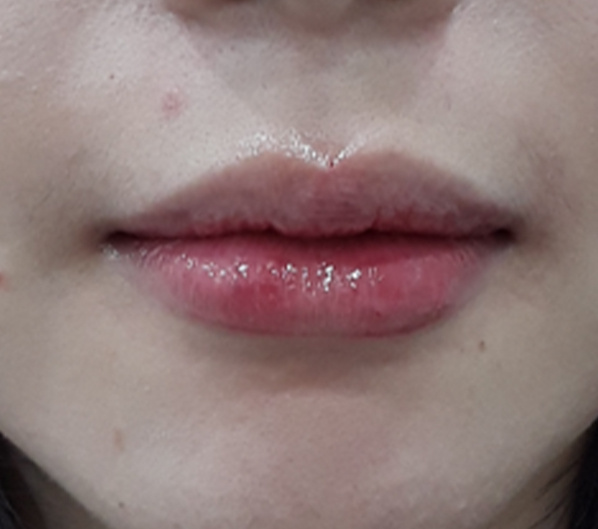 Before