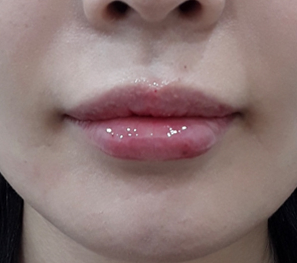 Before