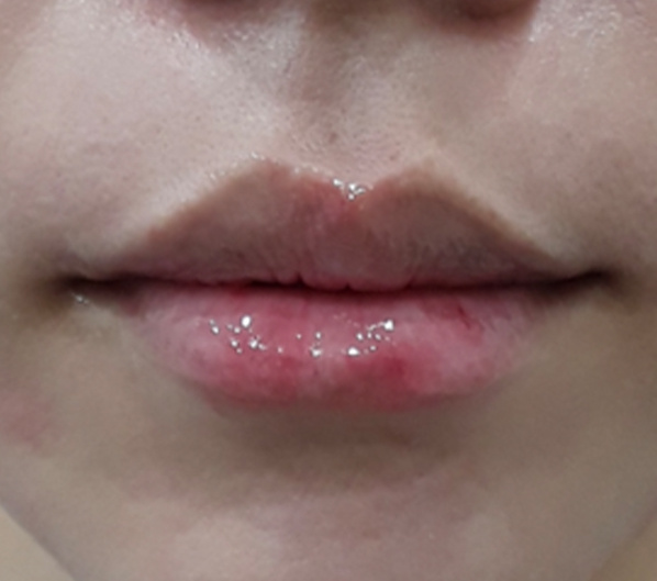 Before