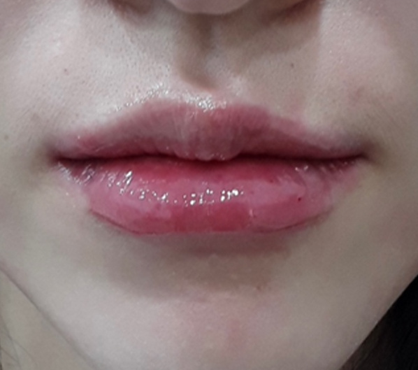 Before