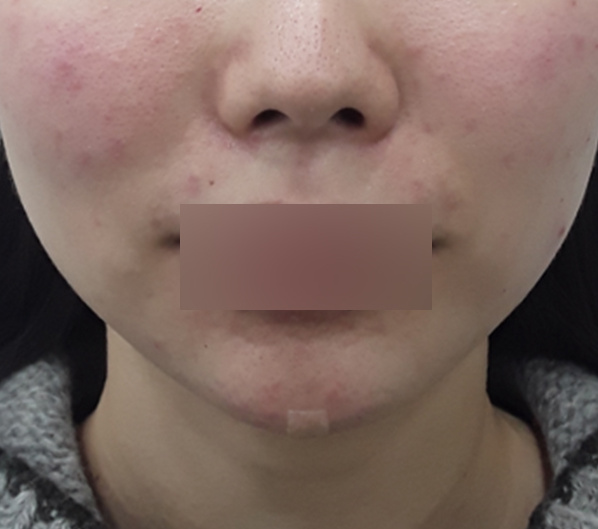 Before