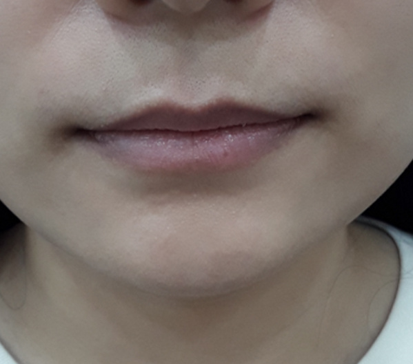 Before