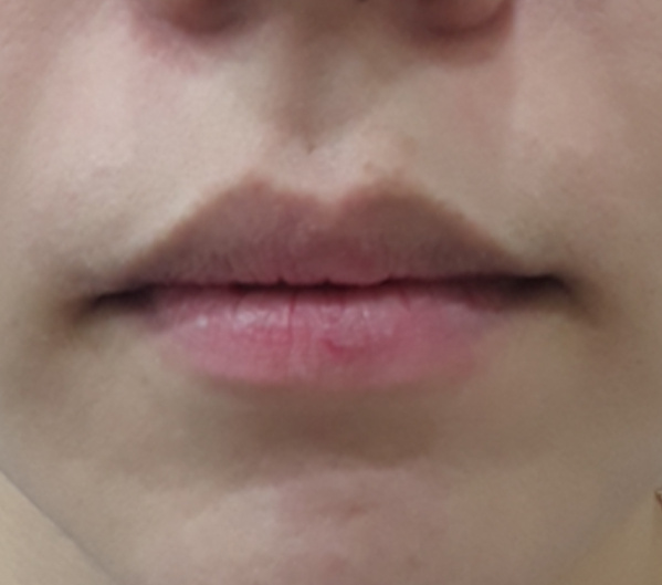Before