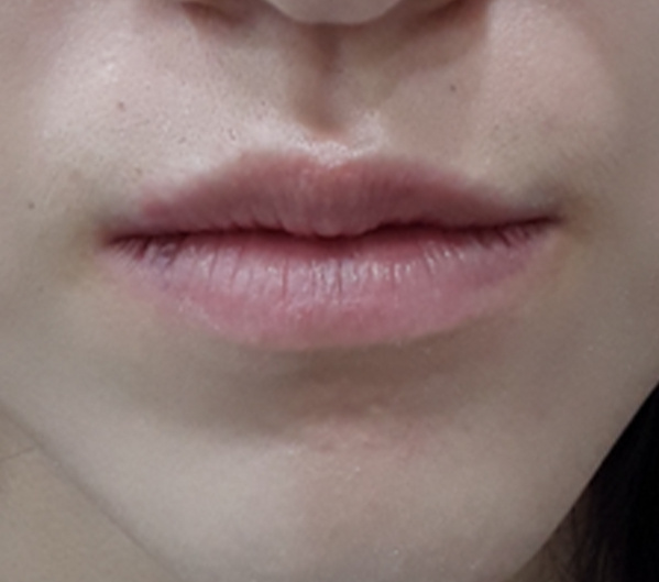 Before