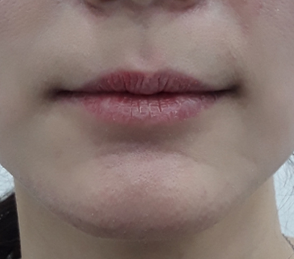 Before