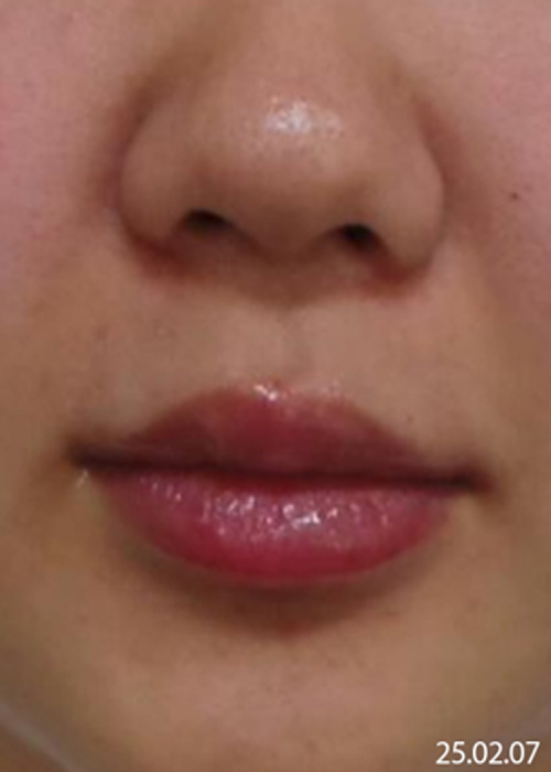 Before