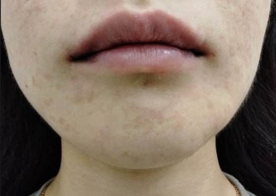 Before