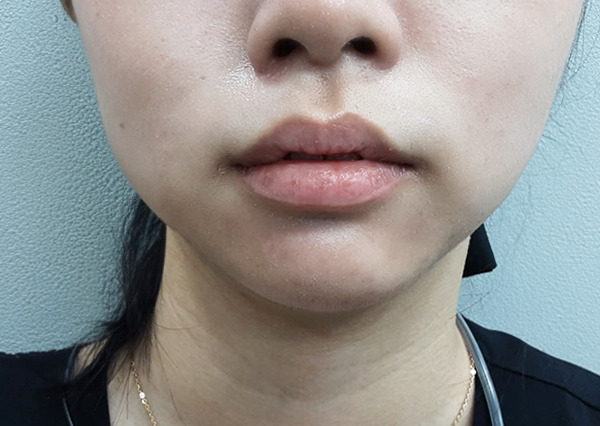 Before