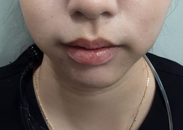 Before