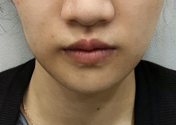Before