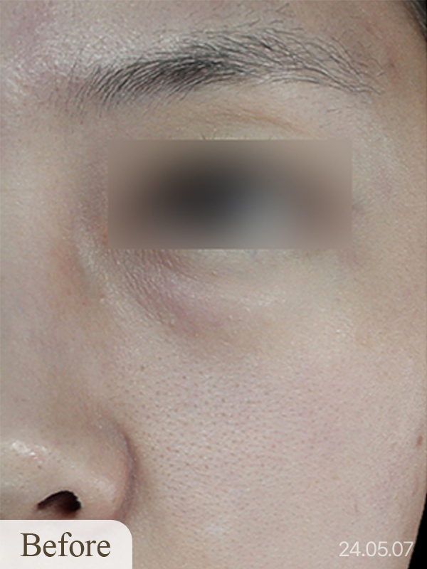 Before