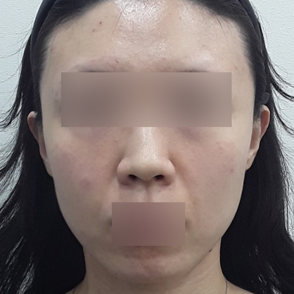Before
