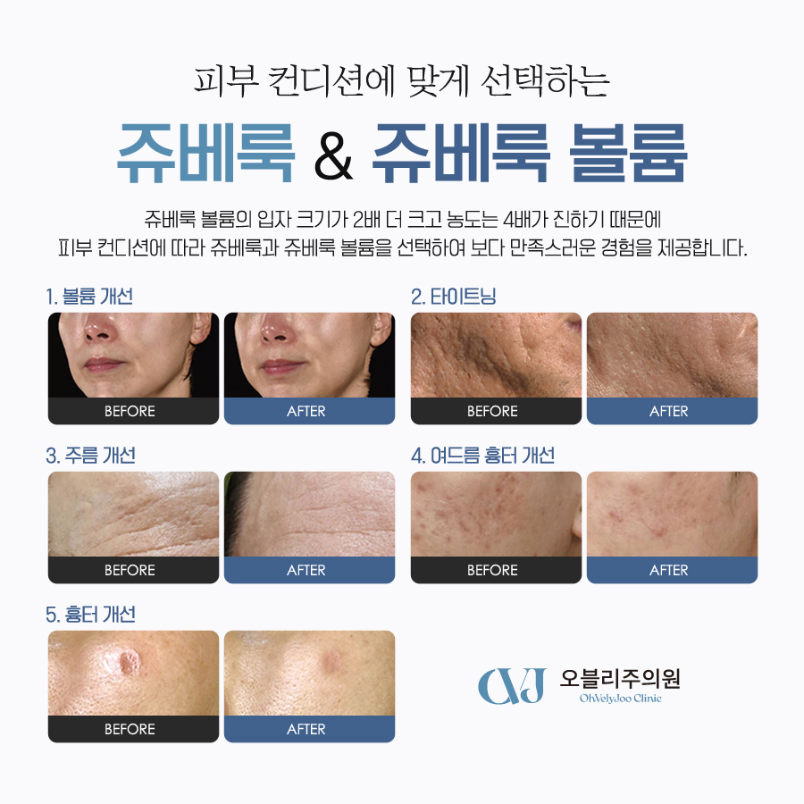 이마 콜라겐 볼륨 쥬베룩 볼륨 콜라움 자연스러운 이마 볼륨 쥬베룩 쥬베룩볼륨 차이