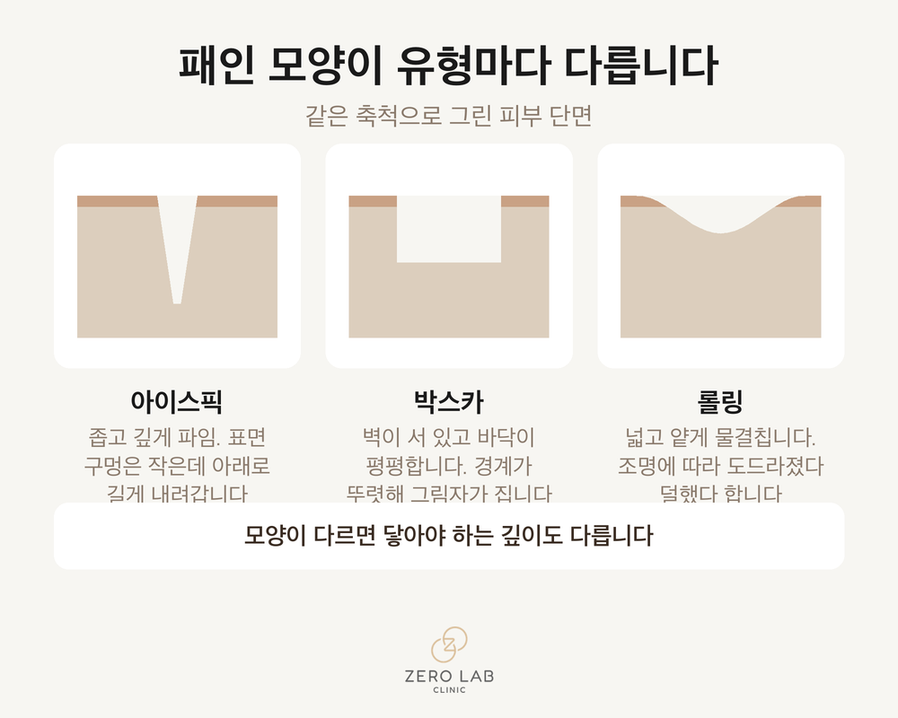 패인 흉터 세 가지 단면 비교