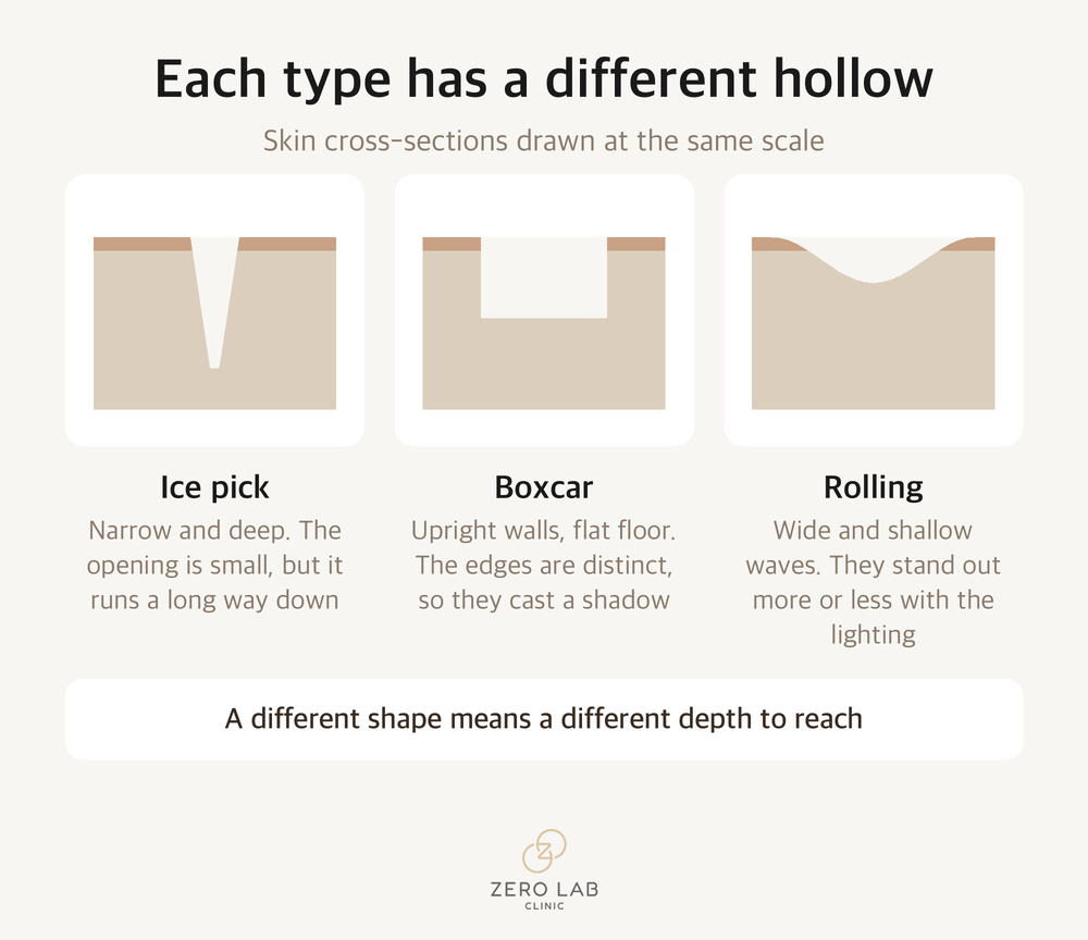 Cross-sections of the three depressed scar types compared