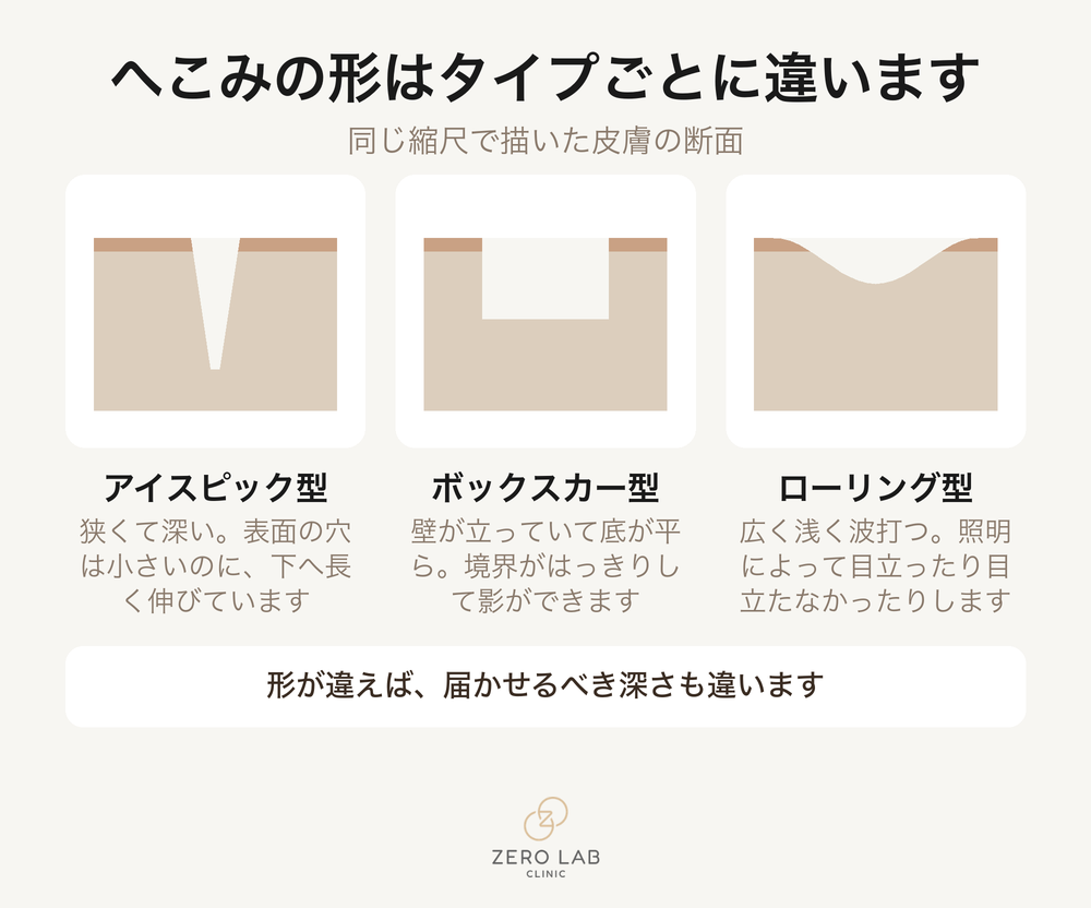 陥凹した跡 三つの断面の比較