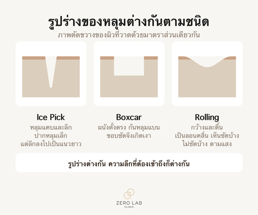 ภาพตัดขวางเปรียบเทียบรอยแผลเป็นชนิดหลุมสามแบบ