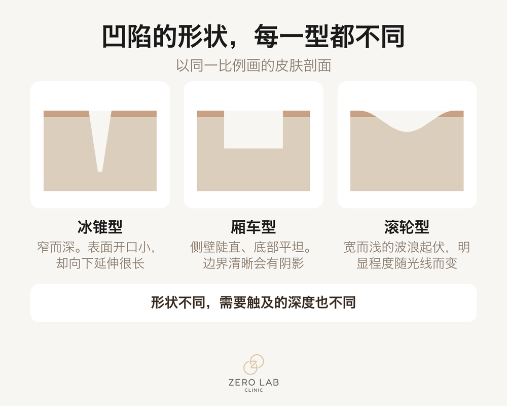 三种凹陷疤痕的剖面比较