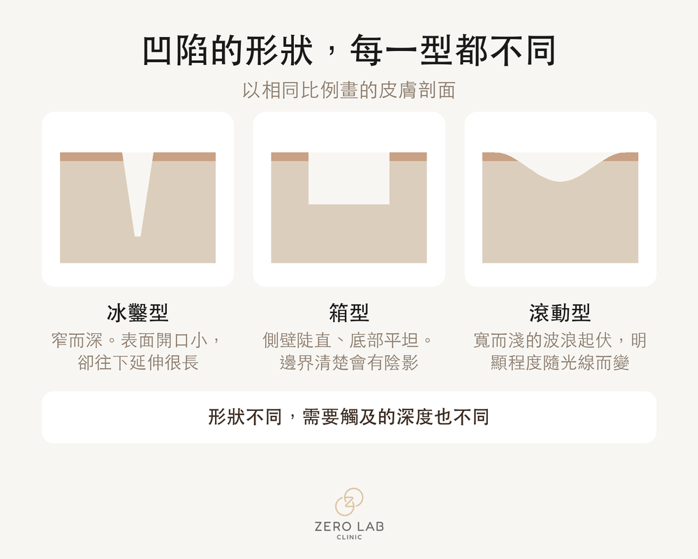三種凹陷痘疤的剖面比較