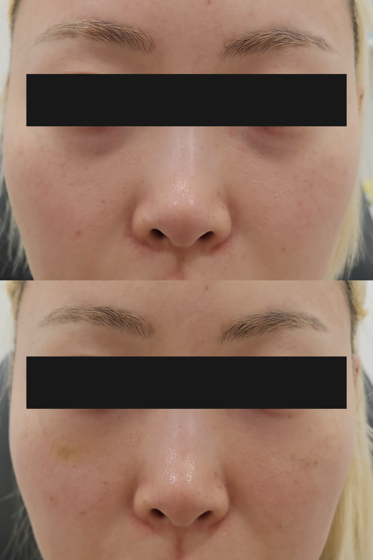 HiloWave under-eye hollow before and after treatment at Sia Clinic Seoul