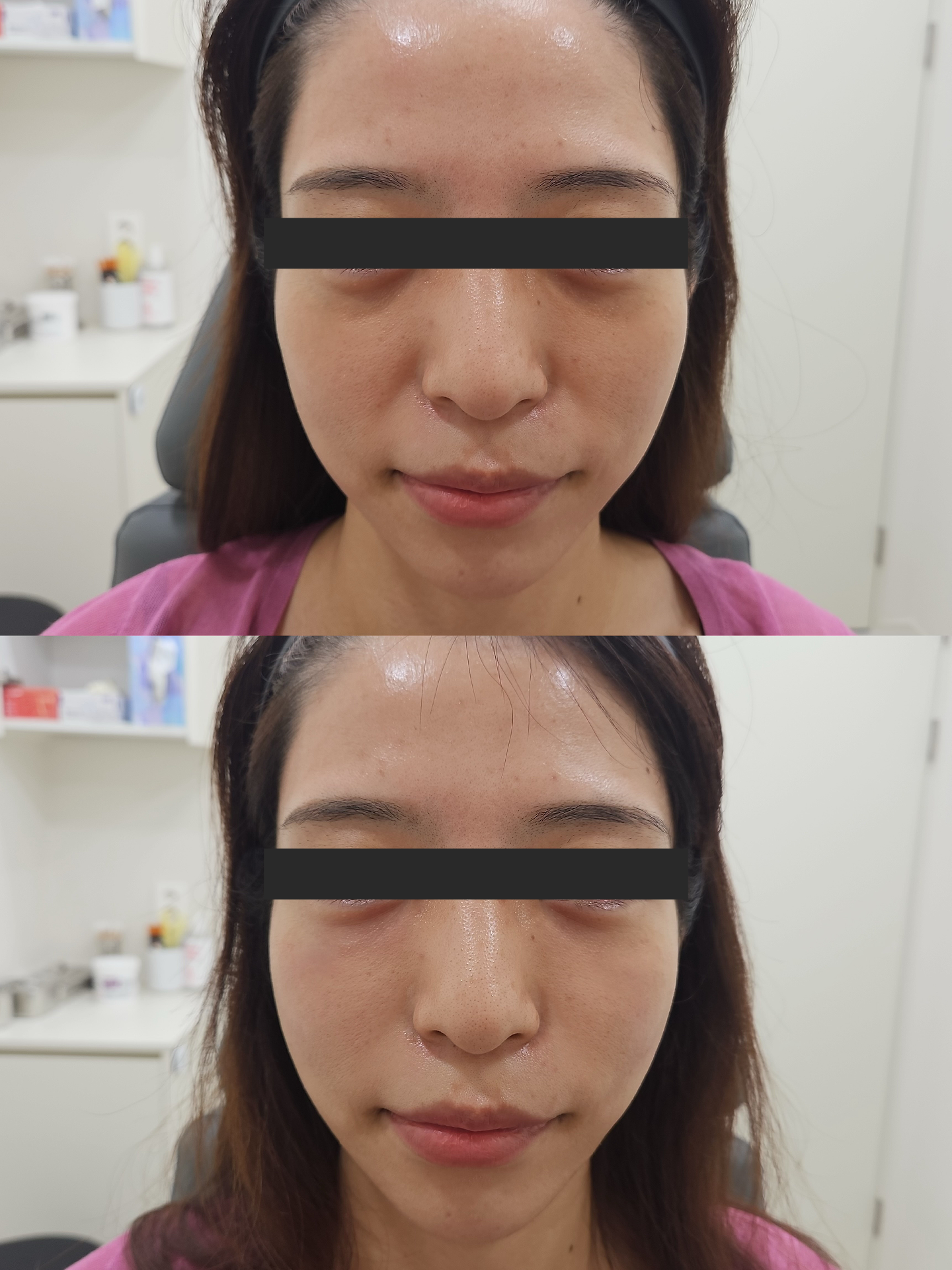 HiloWave cheek volume, Nasolabial Folds and under eyes treatment results before and after at Sia Clinic Seoul