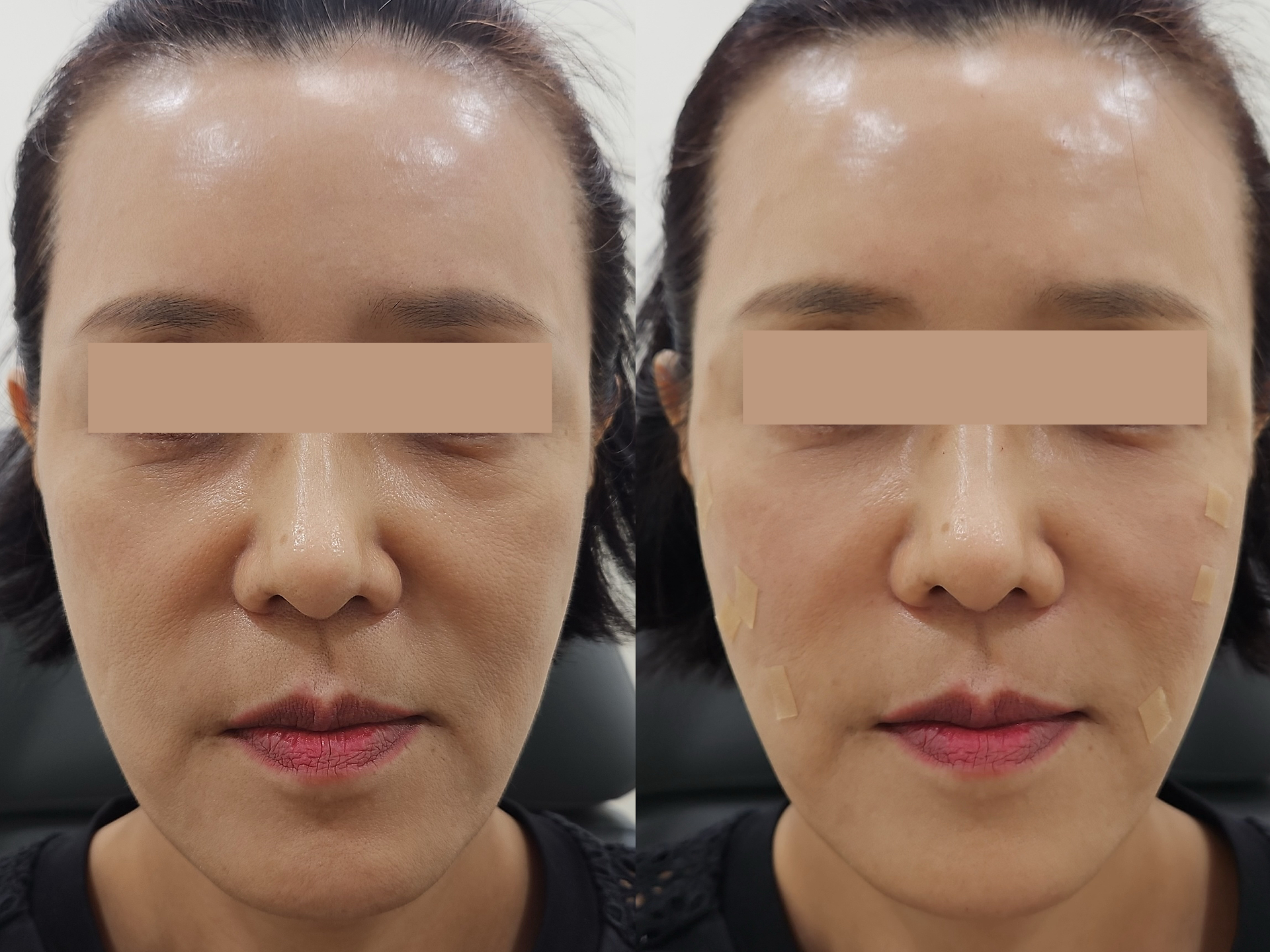 HiloWave nasolabial fold and cheeks 4cc treatment before and after at Sia Clinic Seoul