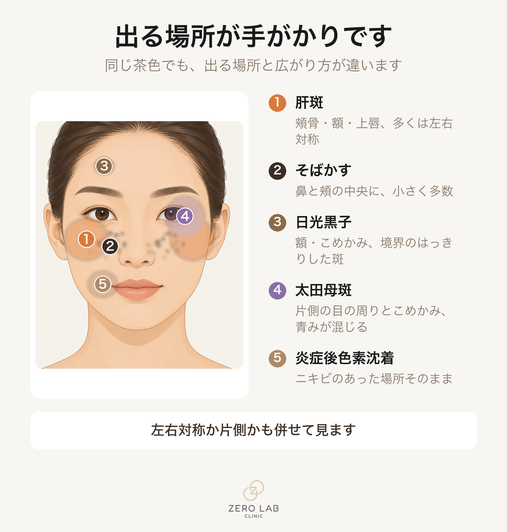 顔で色素ができやすい場所の地図