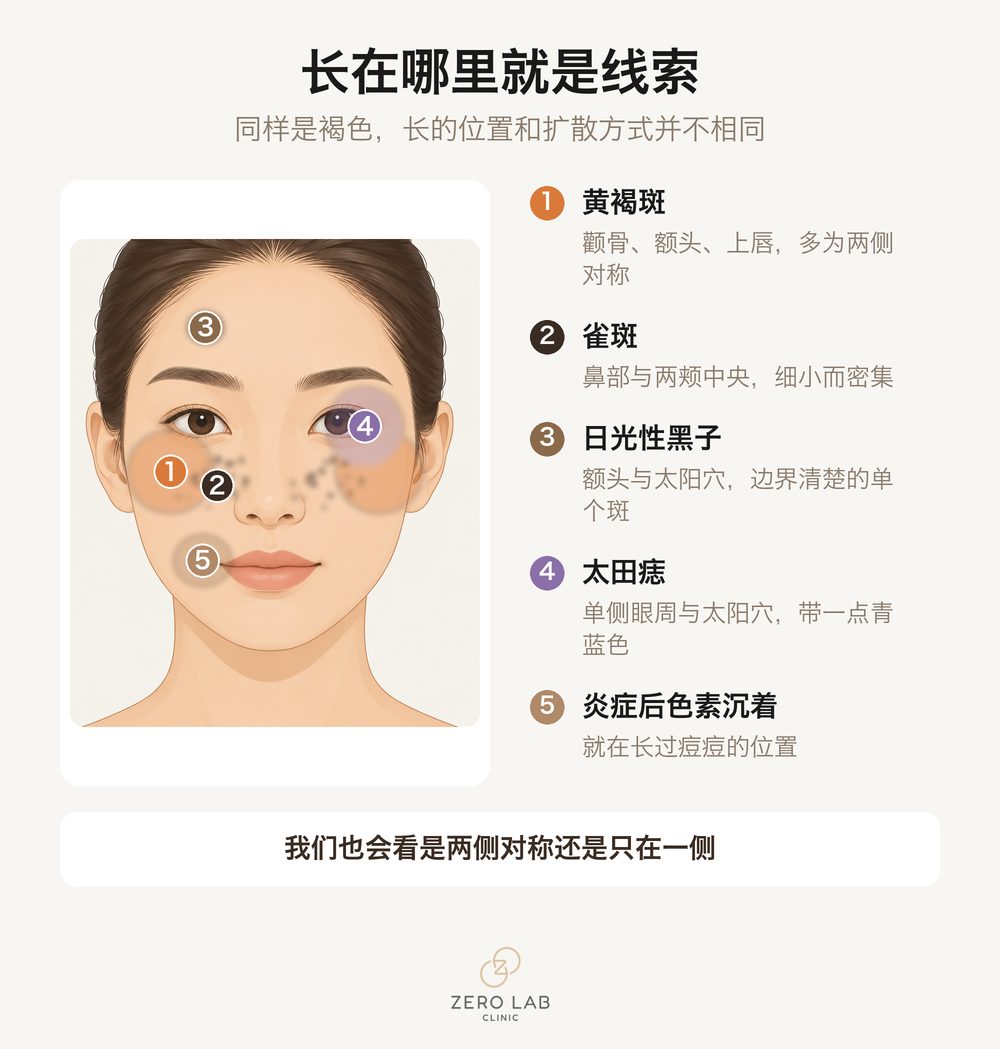 面部色素好发位置分布图