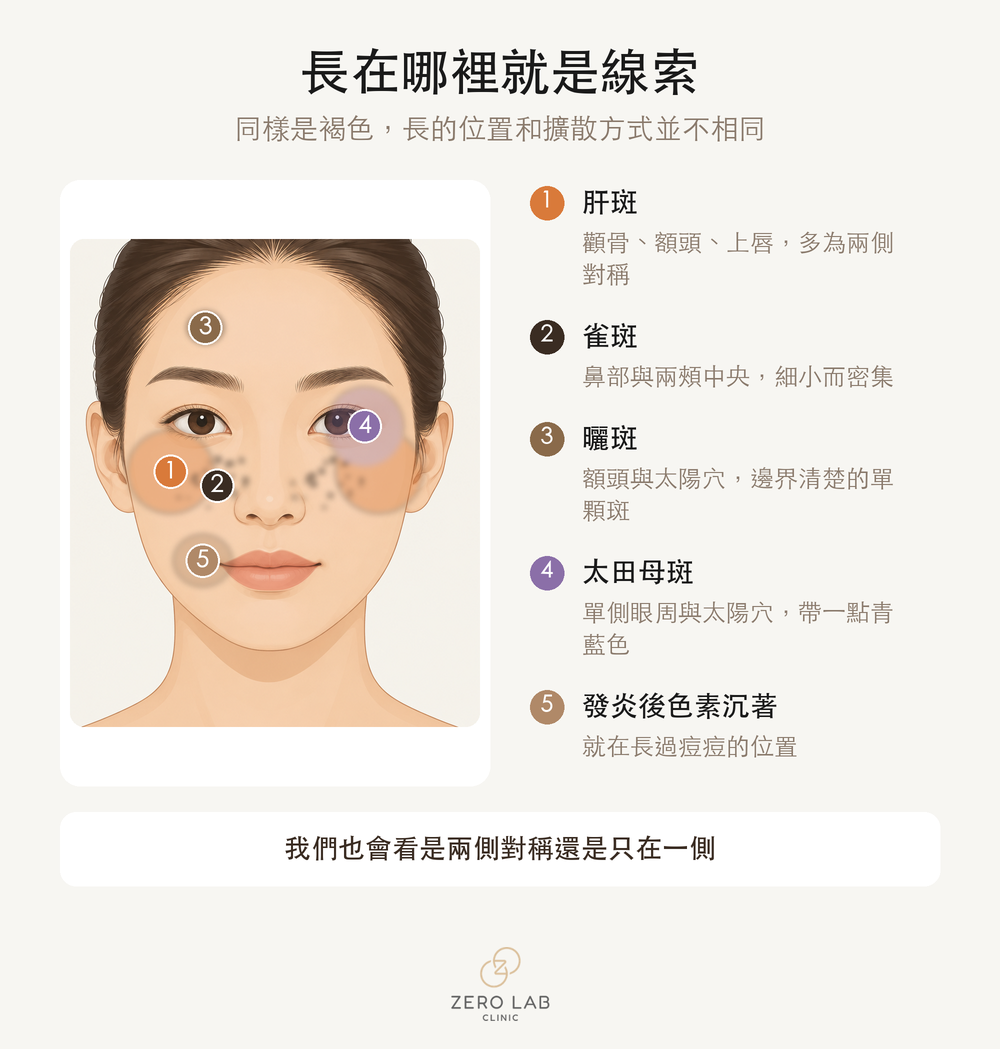 臉部色素好發位置分布圖