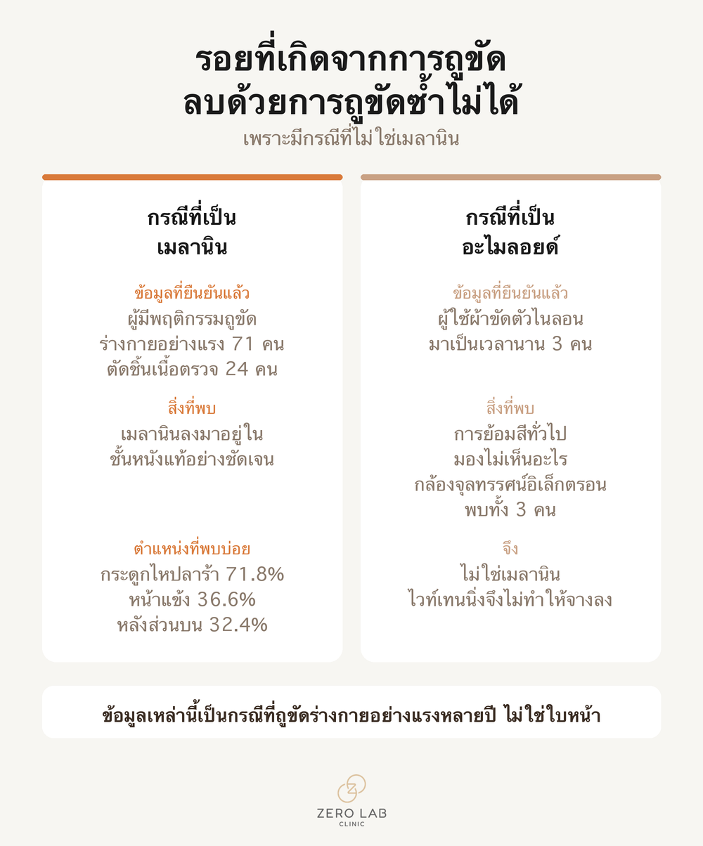 การ์ดเปรียบเทียบที่แยกกรณีรอยจากการถูขัดที่เป็นเมลานิน ออกจากกรณีที่เป็นอะไมลอยด์