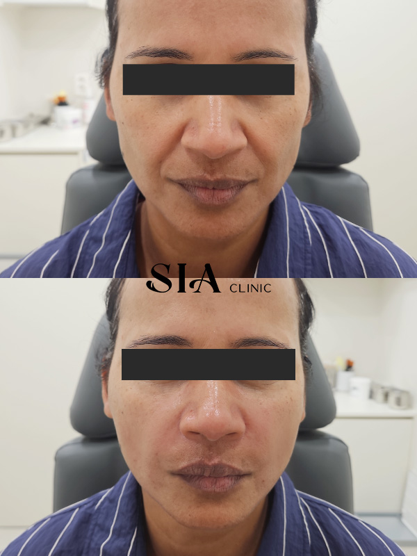 Radiesse nasolabial fold before and after treatment at Sia Clinic Seoul Gangnam