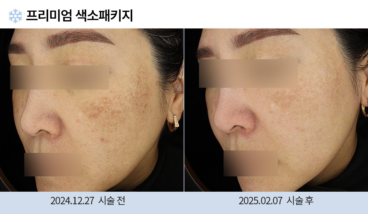 시술 전후 사진