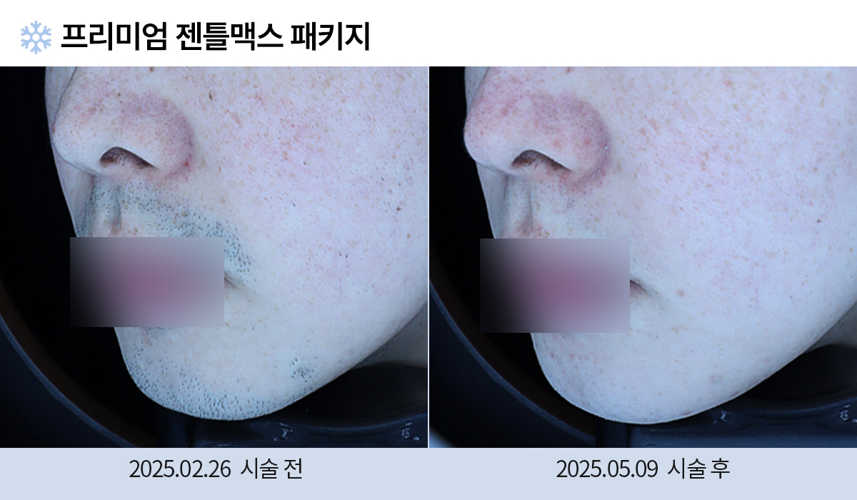레이저 제모 시술 전후 사진