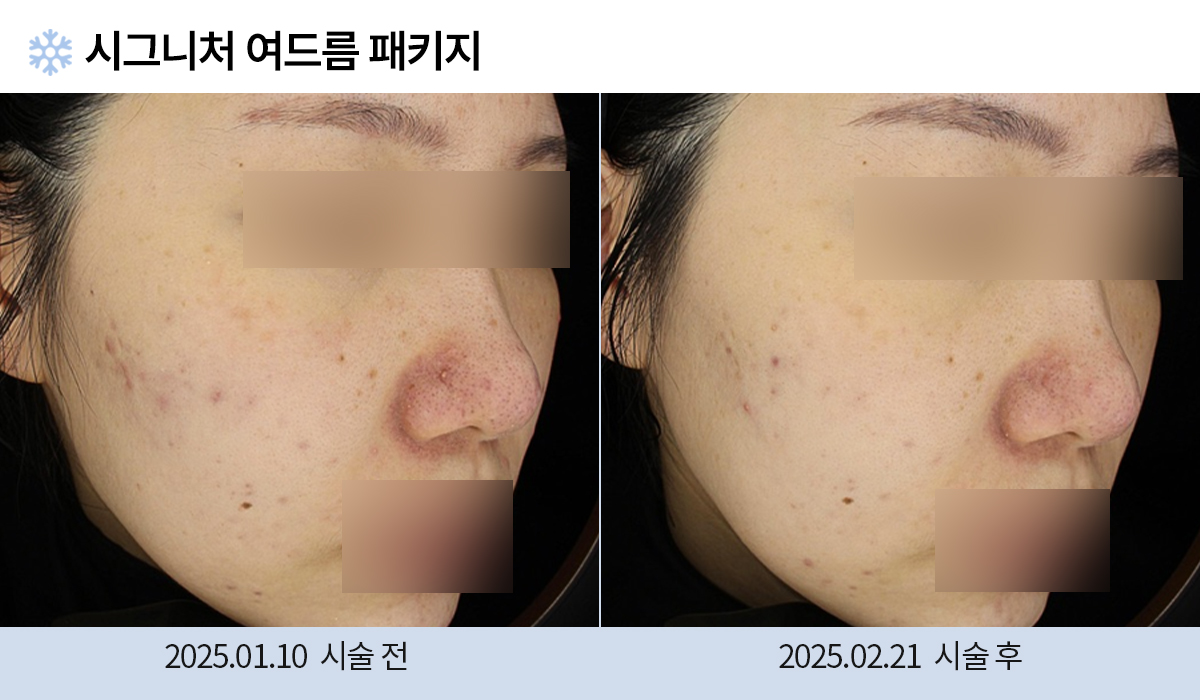 여드름 치료 시술 전후 사진