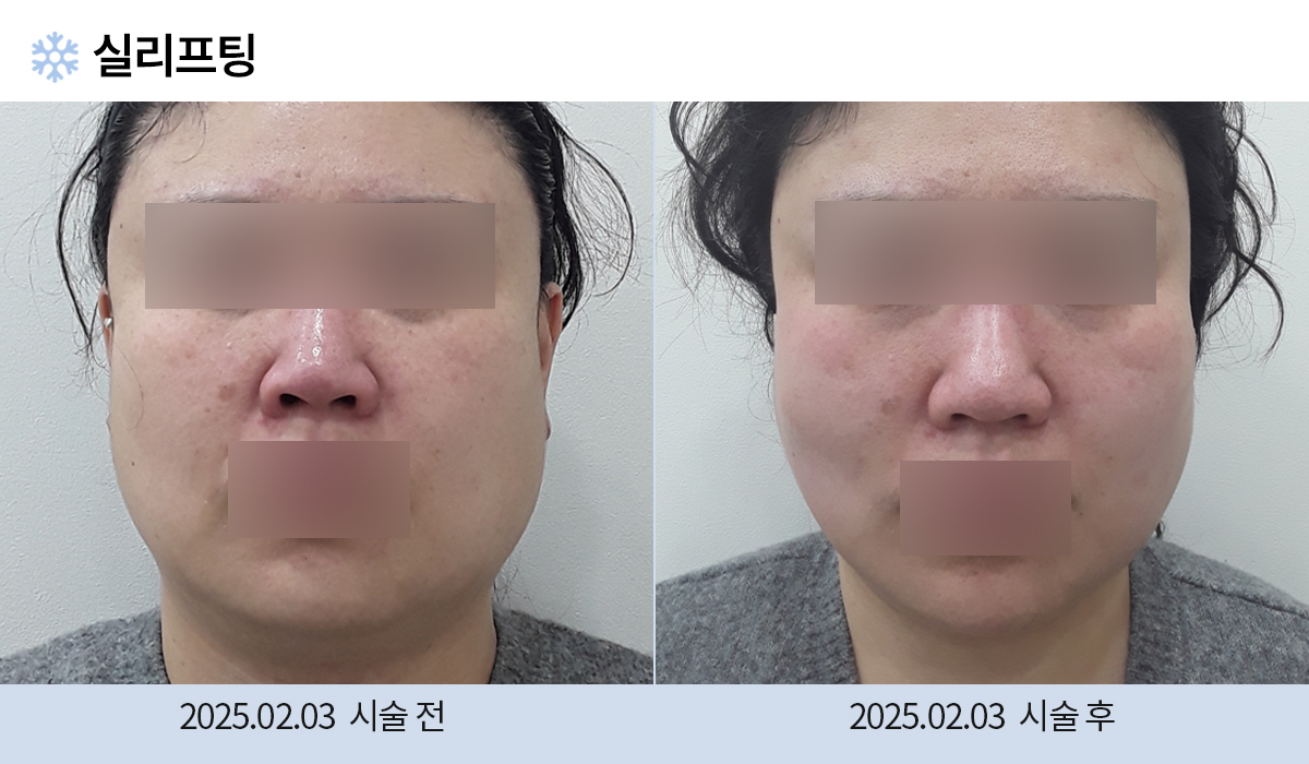 리프팅 시술 전후 사진