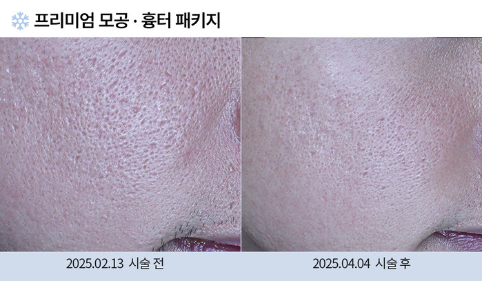 모공 흉터 치료 전후 사진