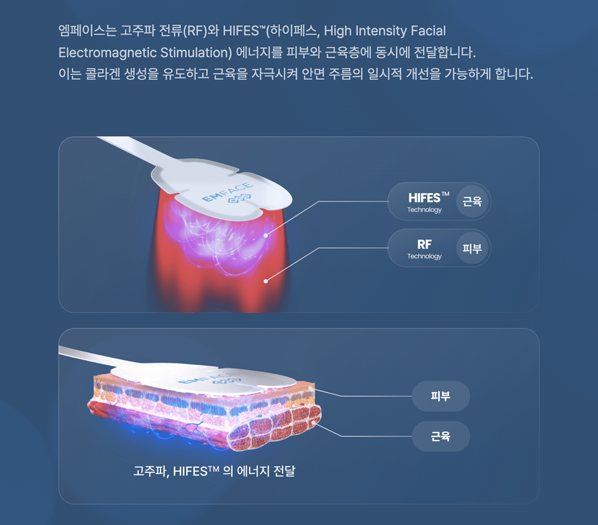 엠페이스 시술 원리