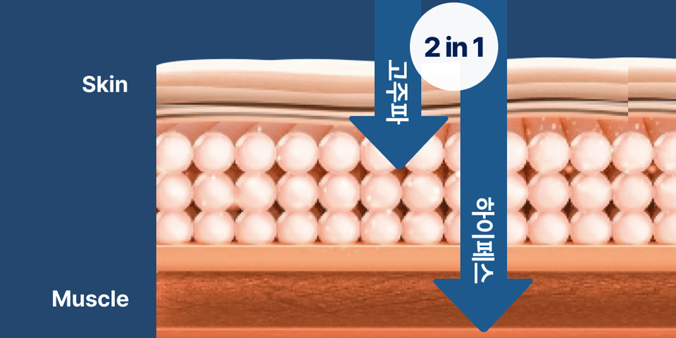 엠페이스 시술 특징