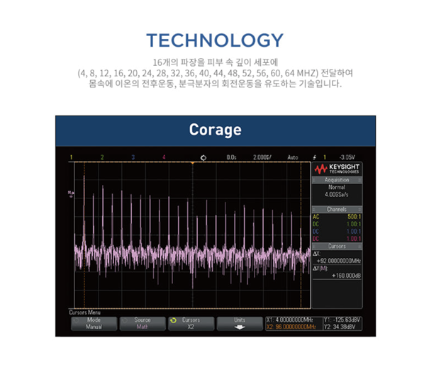 코레지 시술 원리