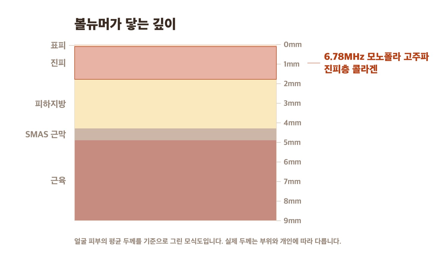 볼뉴머 고주파가 닿는 진피층 단면 모식도
