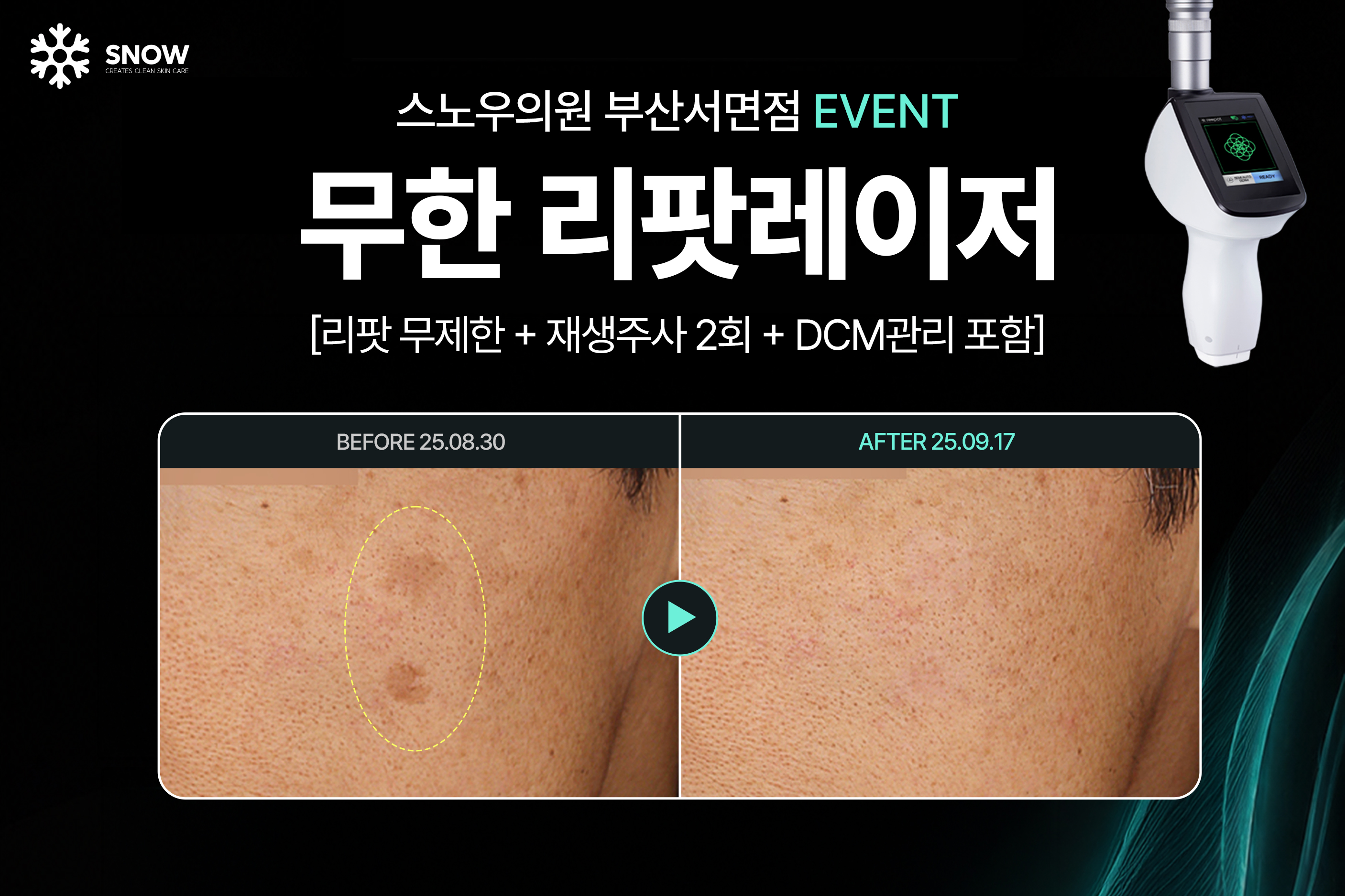 무한 리팟레이저 이벤트