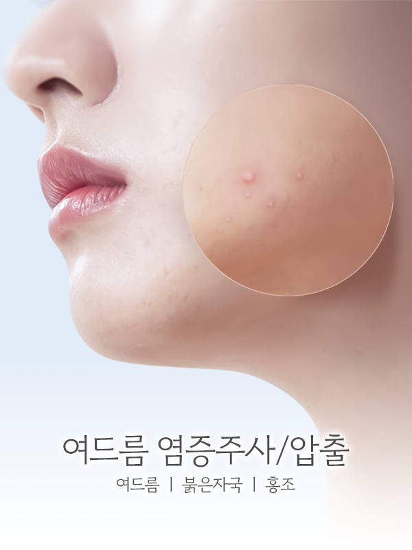 여드름 염증주사/압출