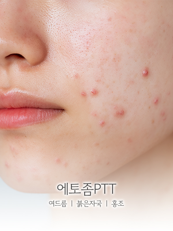 에토좀PTT