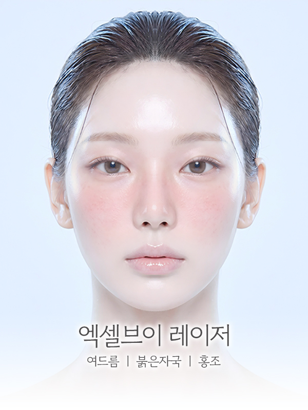 엑셀브이 레이저